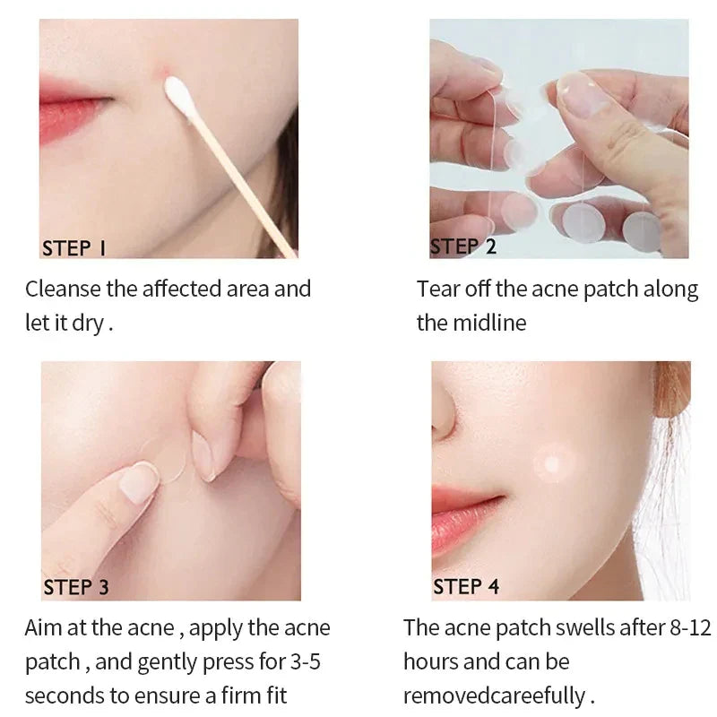 Invisible Acne Patch™ (72 Pcs)